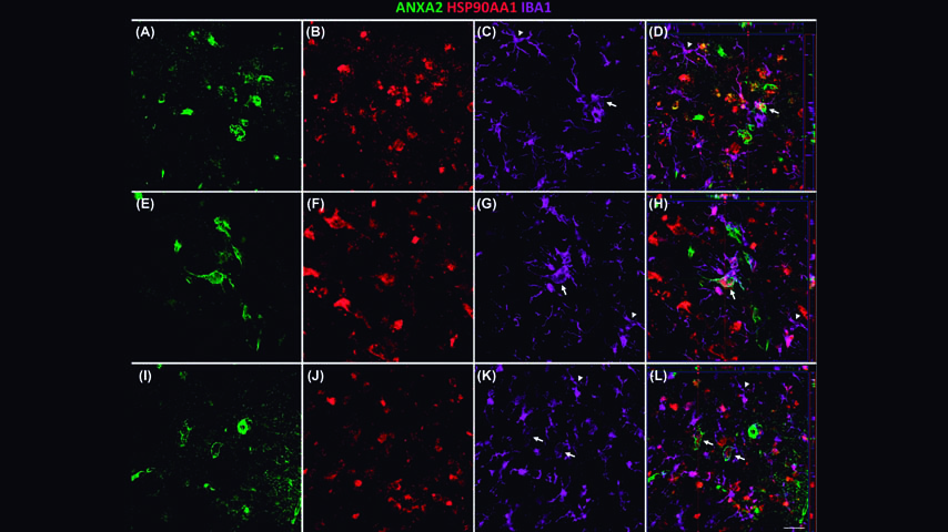 Una investigación de la UCLM que identifica tres proteínas asociadas al alzhéimer podría mejorar su diagnóstico y tratamiento