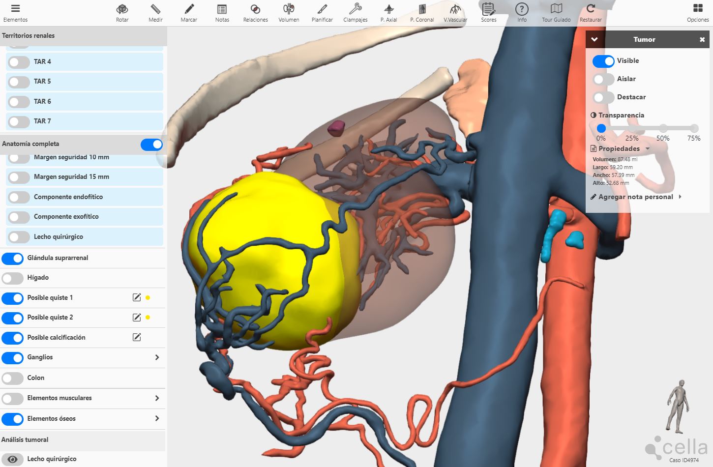 La integración de la IA en modelos 3D permitirá detectar anomalías congénitas en niños según Alexander Siles